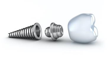 dental implant in 3 pieces | dental implants cookeville tn