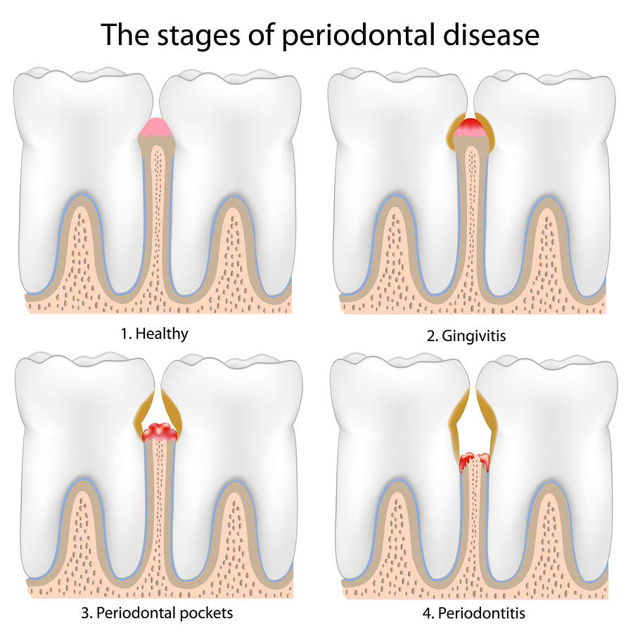 before and after of gum disease treatment in cookeville