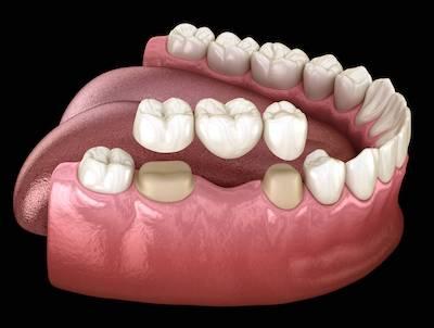 dental bridge in mouth | dental bridge cookeville tn