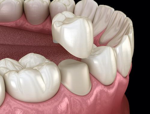 close up of dental crown on tooth | dental crowns cookeville tn