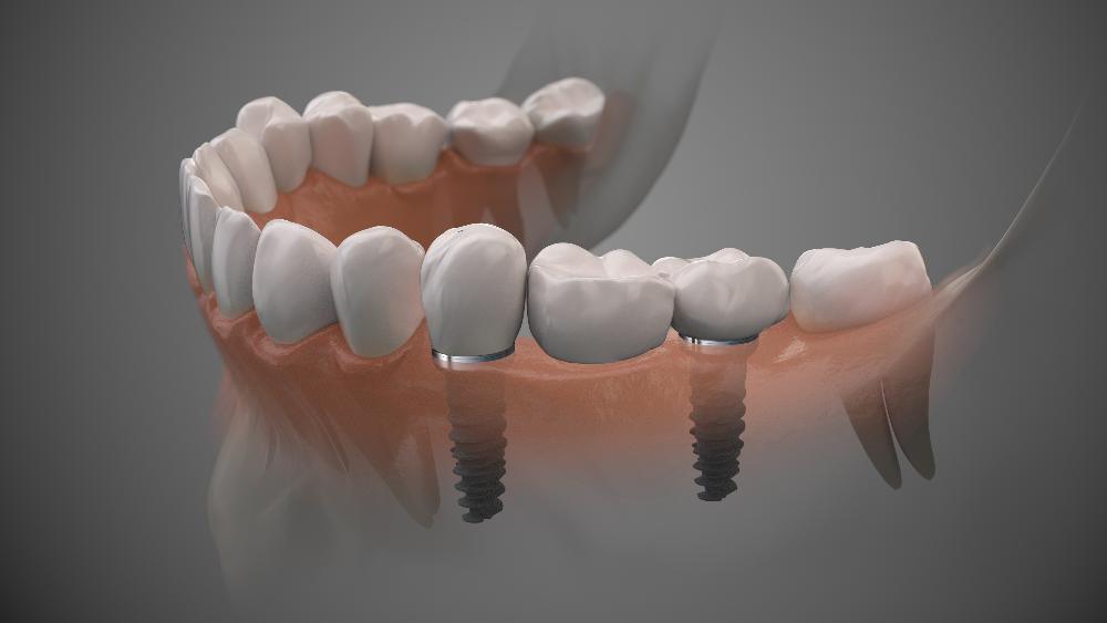 dental bridge in lower jaw model | dental bridges cookeville tn