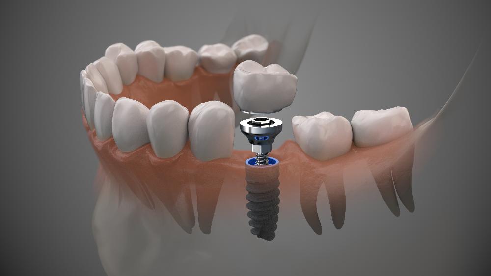 single tooth implant in jaw | dental implant cookeville tn