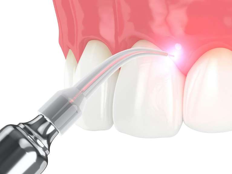 close up of solea laser | sleep apnea treatment cookeville tn