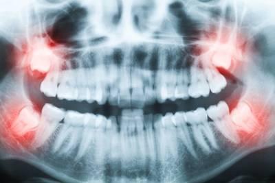 close up of infected teeth | tooth extraction cookeville tn