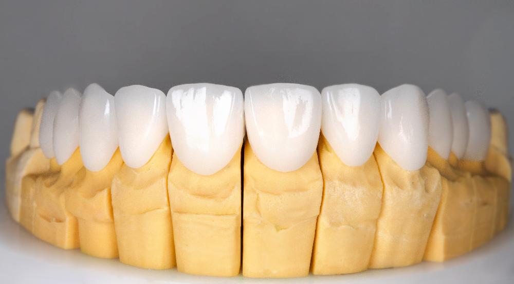 porcelain veneers in mouth mold | veneers cookeville tn