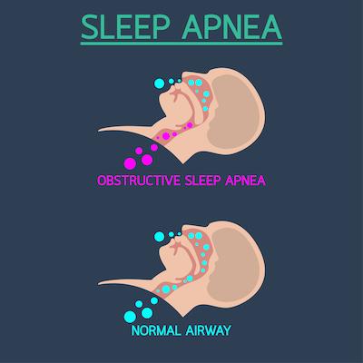 info graphic of sleep apnea therapy | sleep apnea treatment cookeville tn
