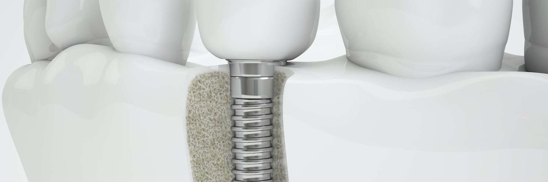 close up of dental implant | dental cookeville tn