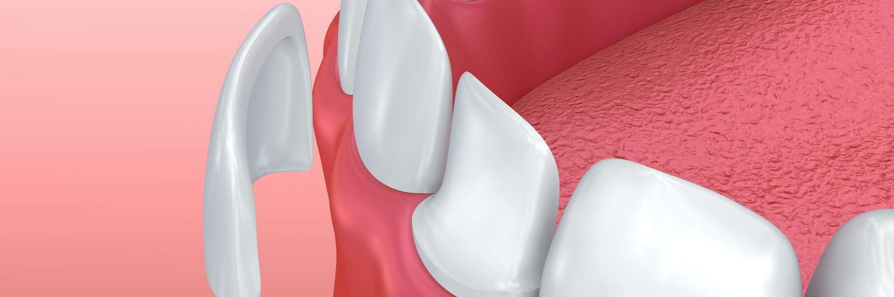 close up of veneer on tooth | dental cookeville tn