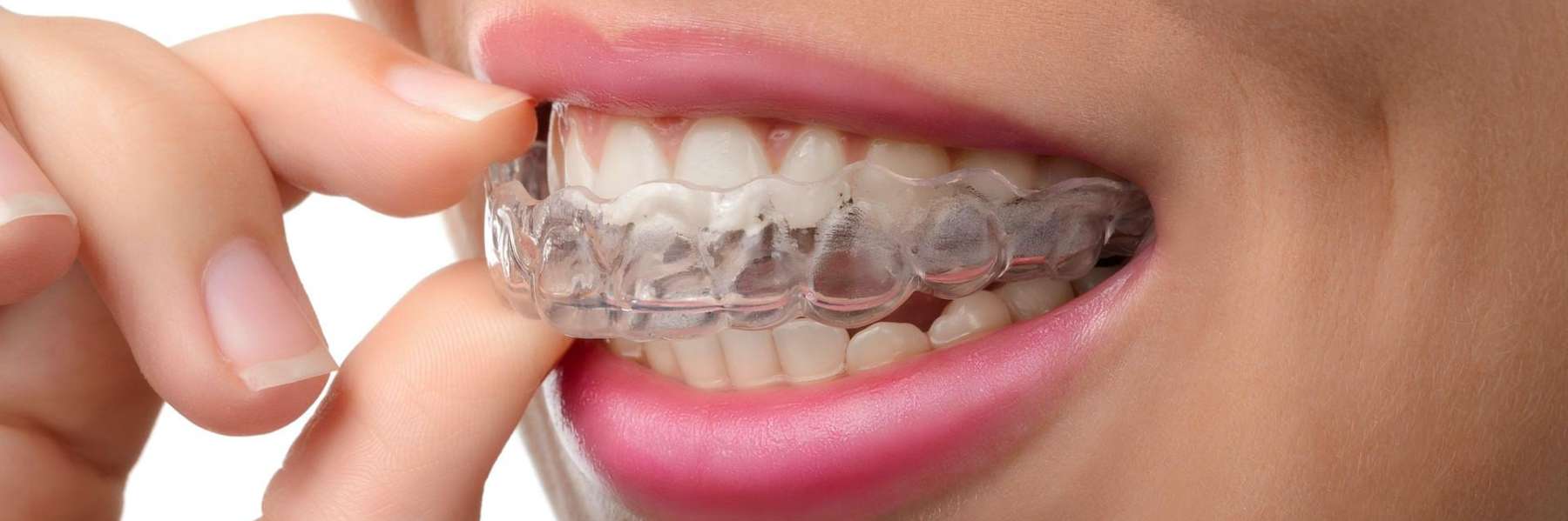 patient putting in clear plastic aligner | dentist cookeville tn