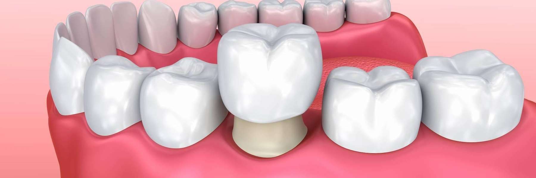close up of dental crown in jaw | dentist cookeville tn