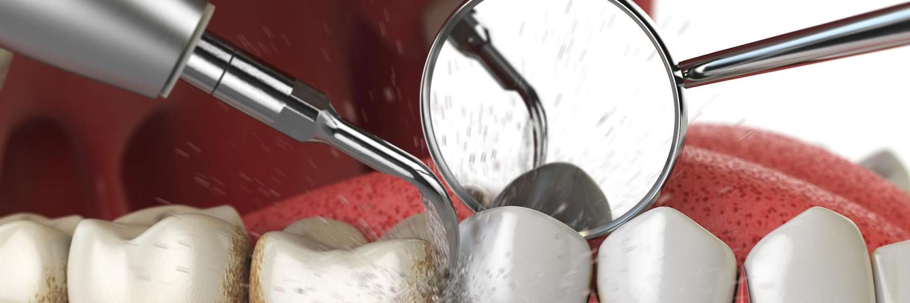 close up of dental exam tool | dentist cookville