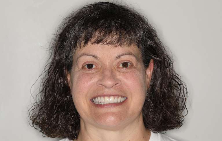 straight and white smile after veneers | cosmetic dentist cookeville tn