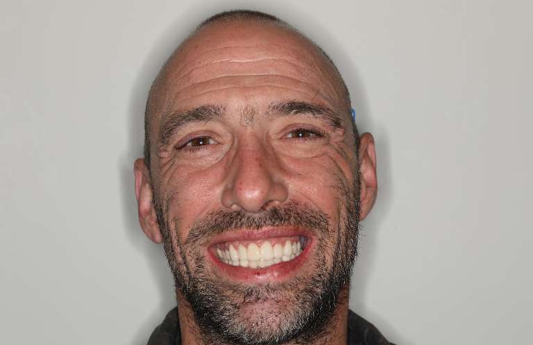 Full-Mouth-Rehabilitation-Before-After-After-Image