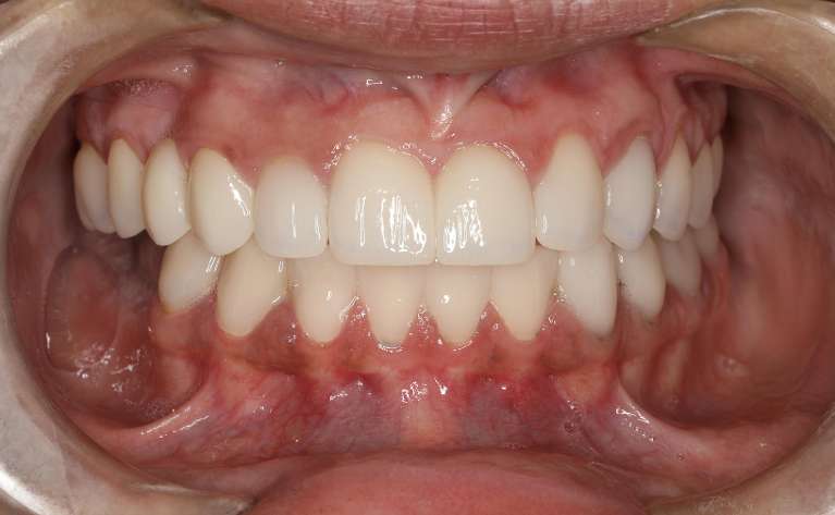 complete and white smile after dental treatment | dental bridge cookeville tn
