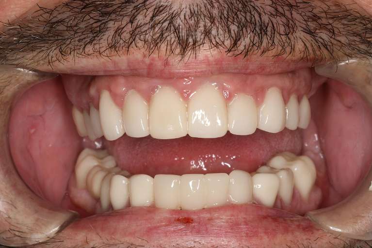 rejuvenated smile after dental in cookeville | dentist cookeville tn