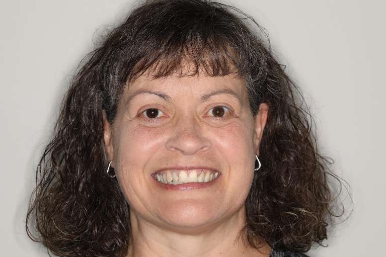 crowded teeth before veneers | veneers cookeville tn