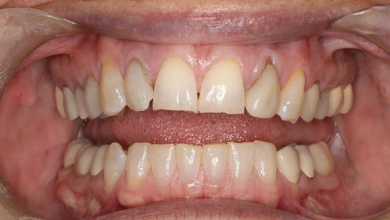 patient's smile before veneers cookeville tn | cosmetic dentist cookeville tn