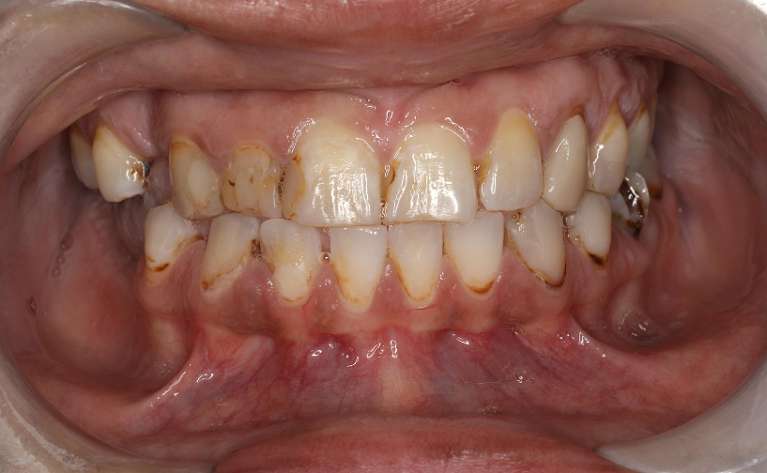 stained teeth before dental treatment | dentist cookeville tn