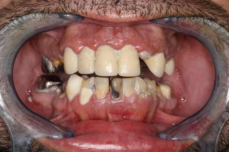 missing teeth before implants in cookeville | hall dental group