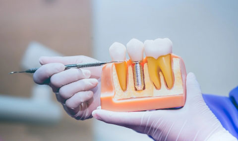 Hall Dental Group
IMPLANTS